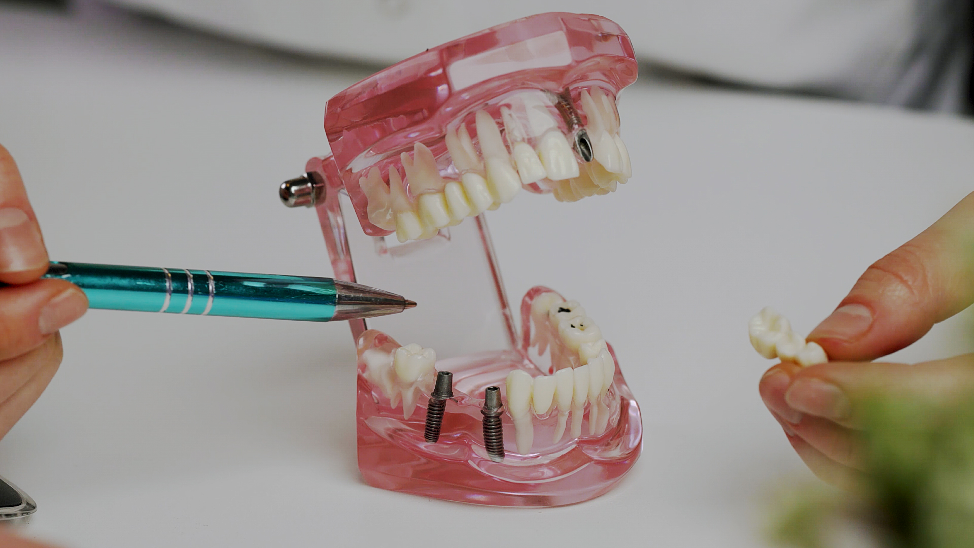Dental Implant Simplified- A basic Implant surgery and prosthetic course.